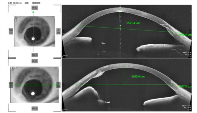 （前节OCT显示患者眼球破裂伤）