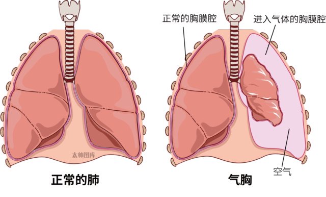 方大同去世，曾因“爆肺”消失8年，什么是“爆肺”？