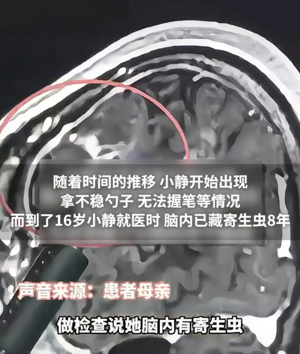 医生从少女脑中揪出一条10余厘米活的裂头蚴,网友:再也不吃了