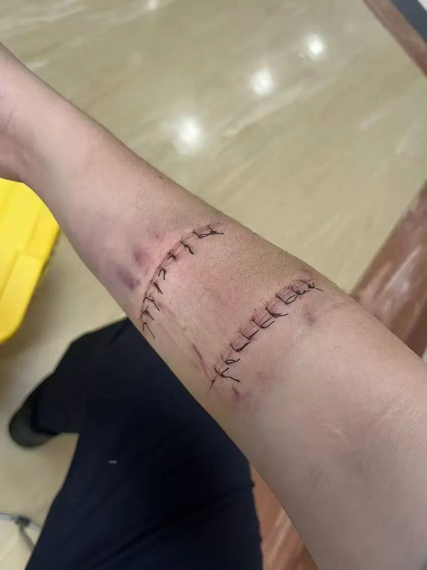 杨建明手臂的伤疤。