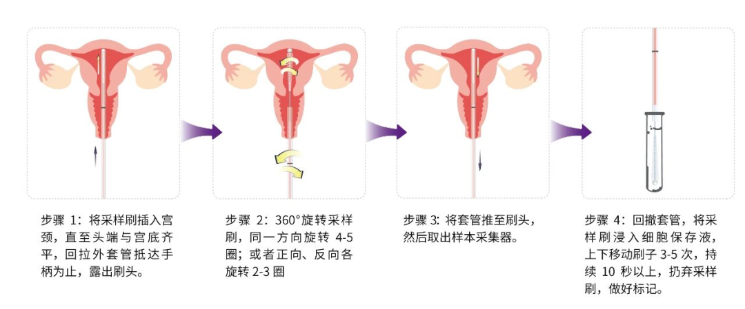 子宫内膜取样怎么取三基因甲基化检测：捕捉子宫内膜癌“隐秘信号”！_https://www.jmylbn.com_新闻资讯_第7张