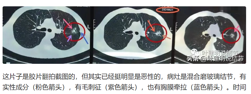 杭州市肿瘤医院胸外科医生对李先生此前体检报告的看法。