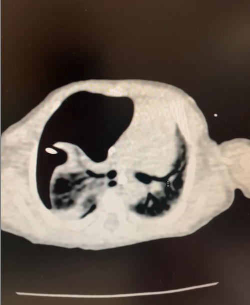 患儿术前CT示右侧大量气胸