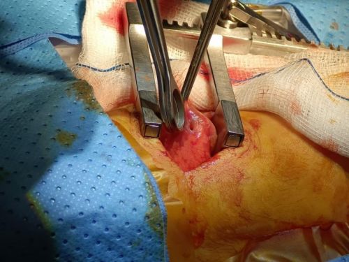 术中探查右肺下叶瘘口