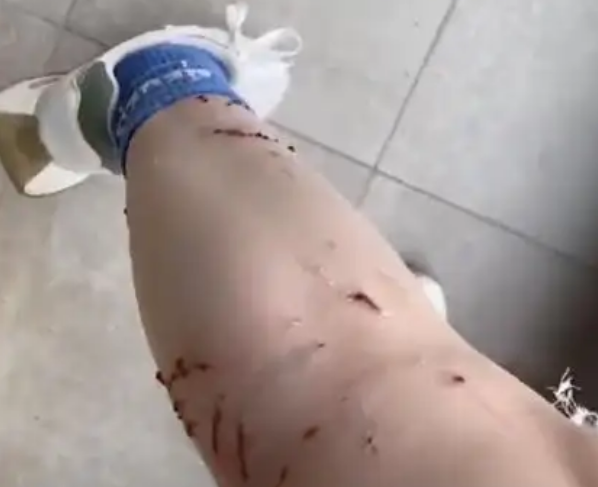 女人的脚溃疡是由宠物猫引起的：接种疫苗的成