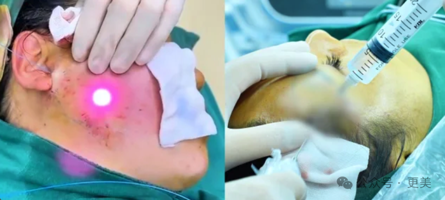 △光纤vs射频吸脂