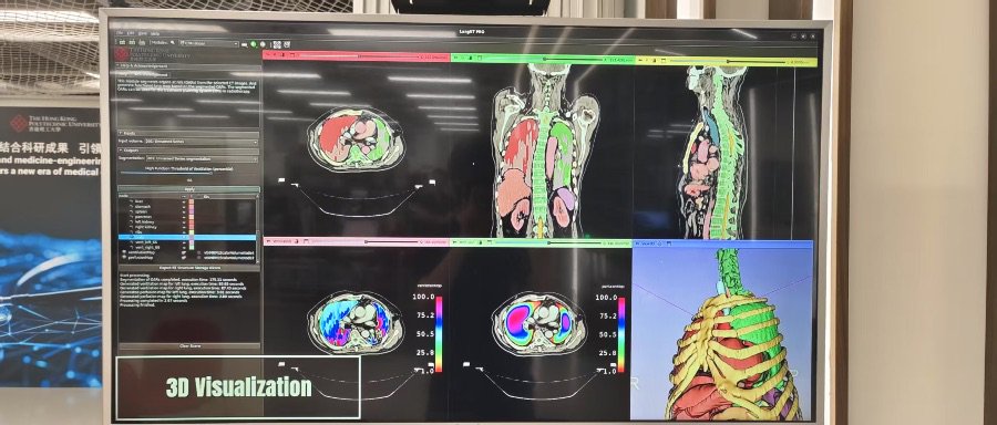 蔡璟团队研发的自动分析患者CT影像生成肺部功能影像人工智能系统，拍摄：实习生莫林衛