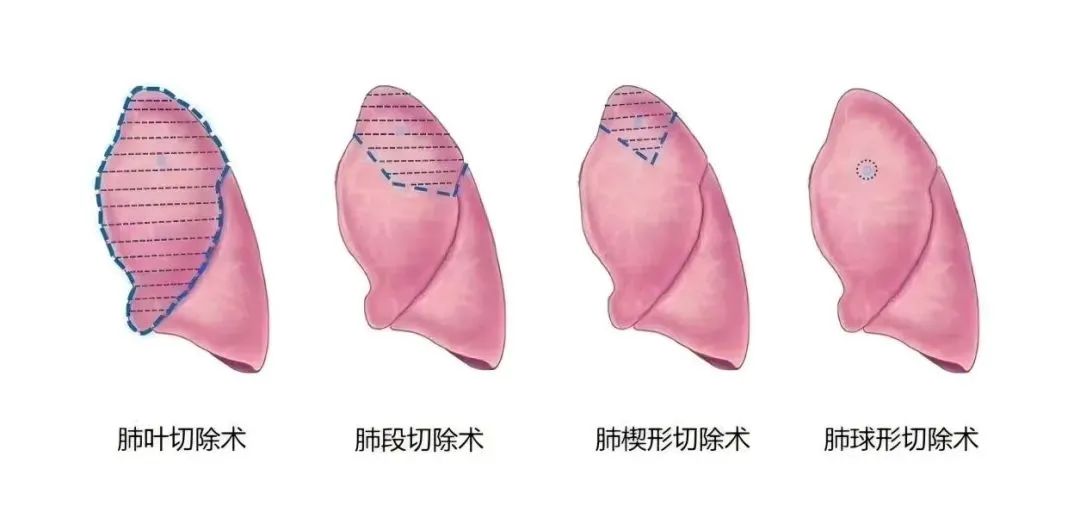 复拓知达携手华西医院完成全球首创经皮穿刺肺结节球形切除术人体可行