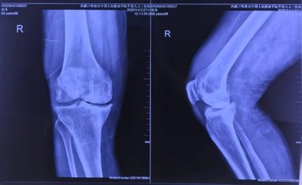 (图文:患者术前CT)