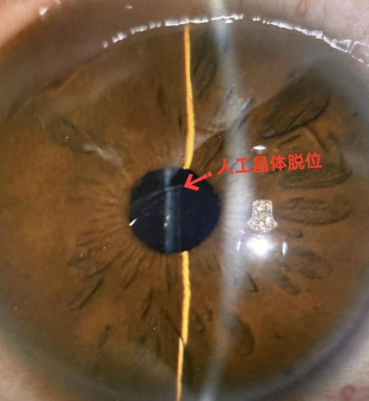 北京高度近视患者眼球软如"豆腐"险失明,闵寒毅教授妙手解危局