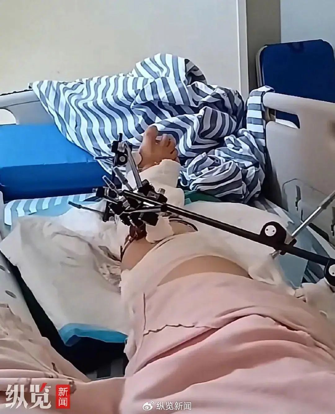 彭惠芳称她的右脚粉碎性骨折,左腿骨裂开