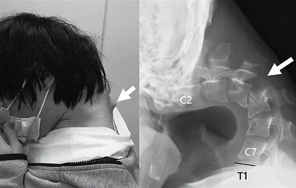 一个25岁的日本男子迷上了他的手机。他的脖子有