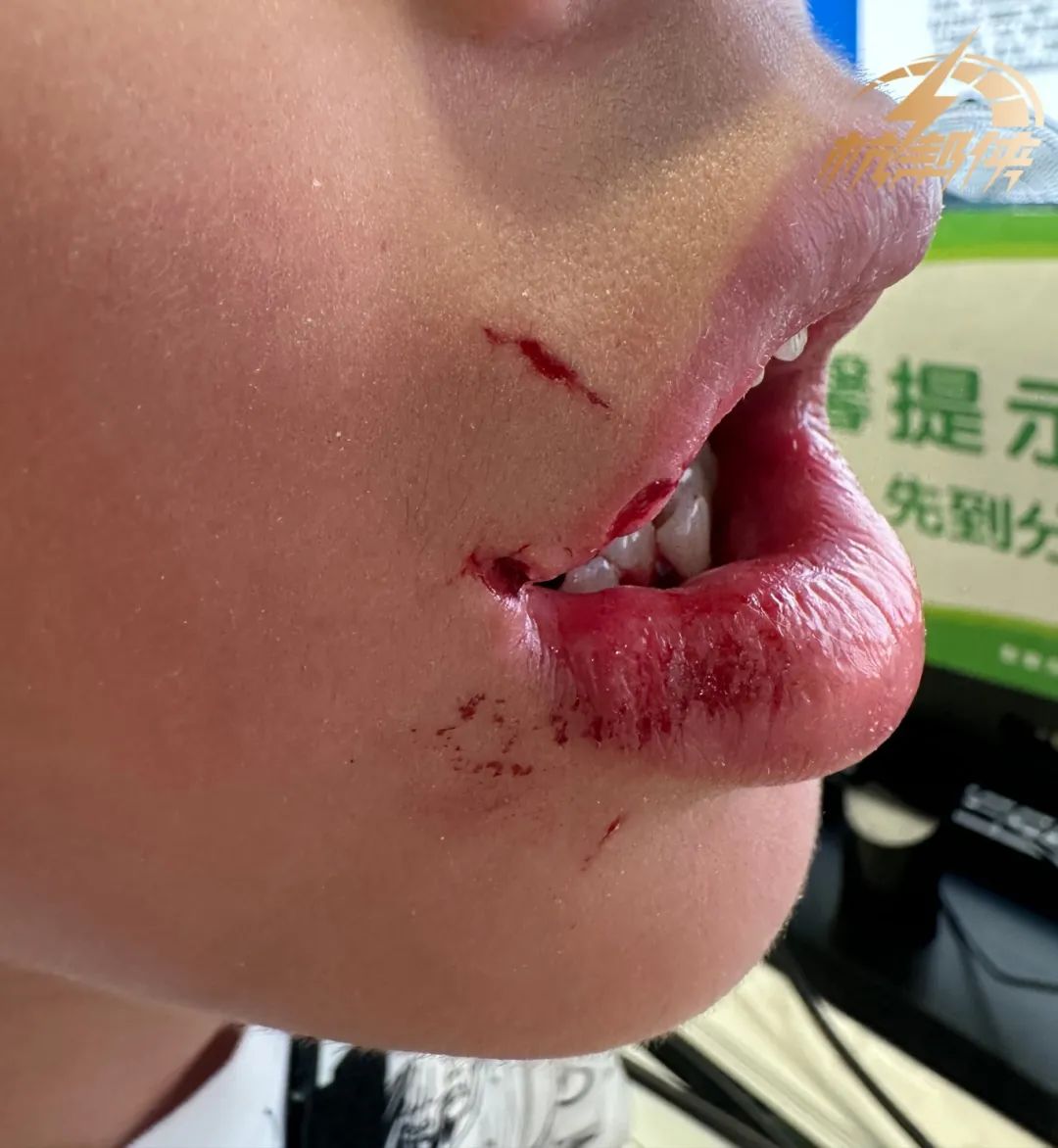 12岁男孩嘴巴瞬间被割裂!周边商户:一到晚上就看不清