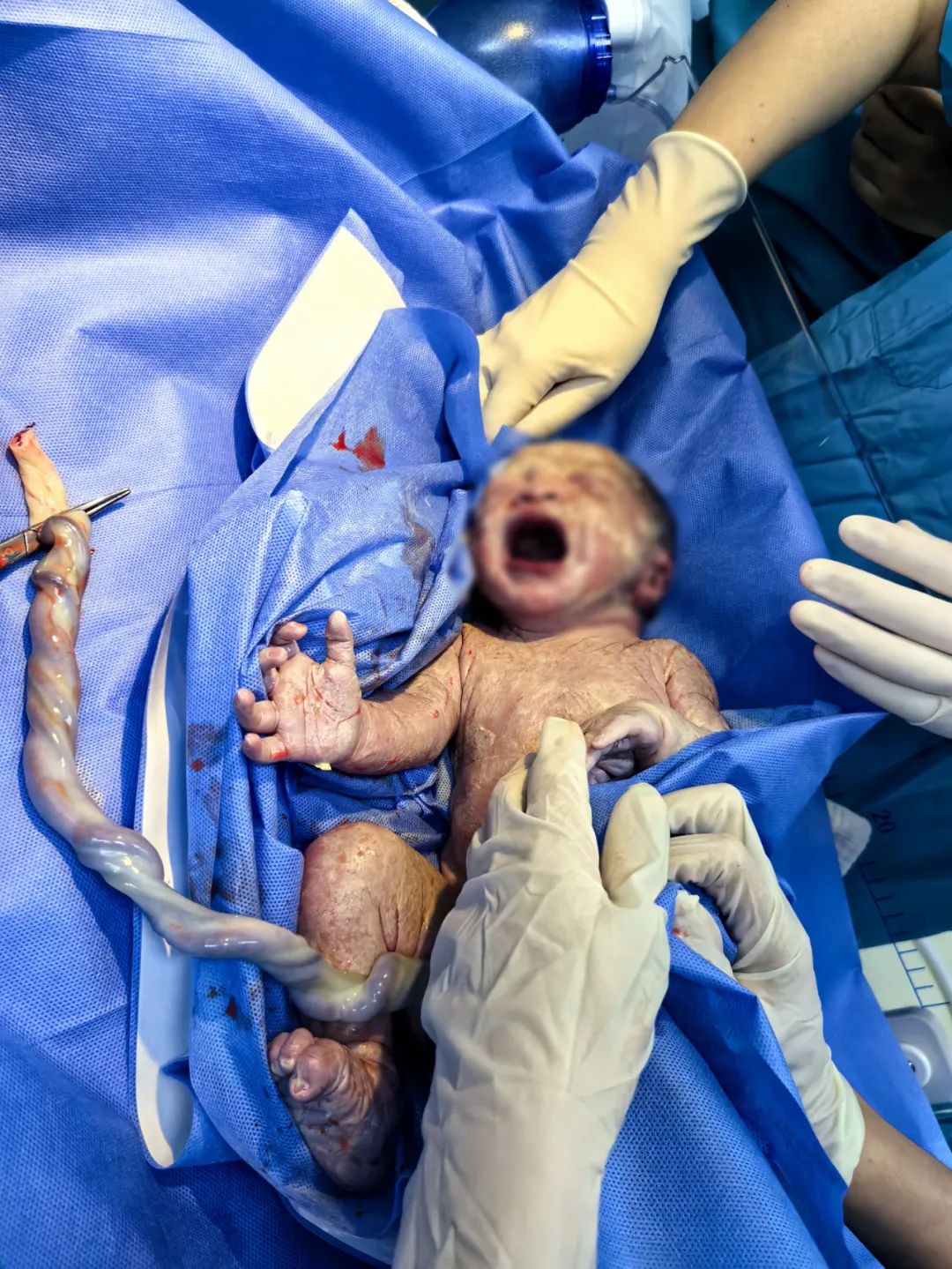 怀孕35周,1/5血流逝,20 医护极限抢救