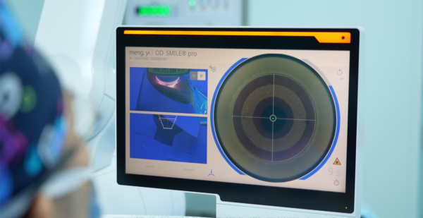 SMILE pro手术，飞秒激光扫描中