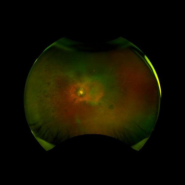 刘叔叔眼底照片