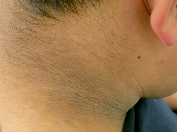 图 2、3. 典型的黑棘皮病（来自参考资料）