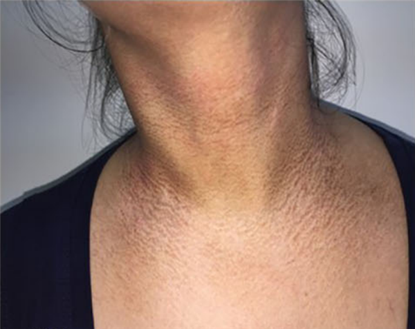 图 4. “脏颈征”（来自参考资料）