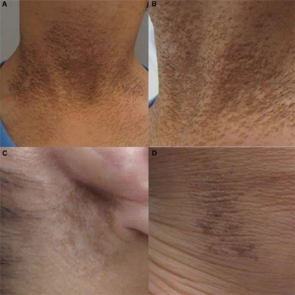 图 6. Terra firma-fome 皮病（来自参考资料）