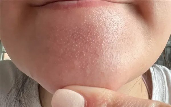 图 4. 主要是正常的毛囊皮脂腺，</p><p cms-style=