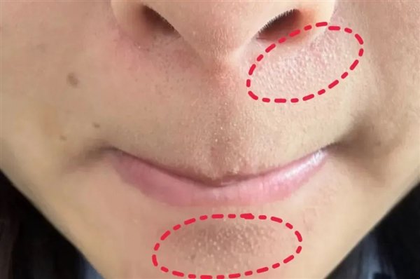 真的想问：下巴凸起的小颗粒 到底是什么呀！