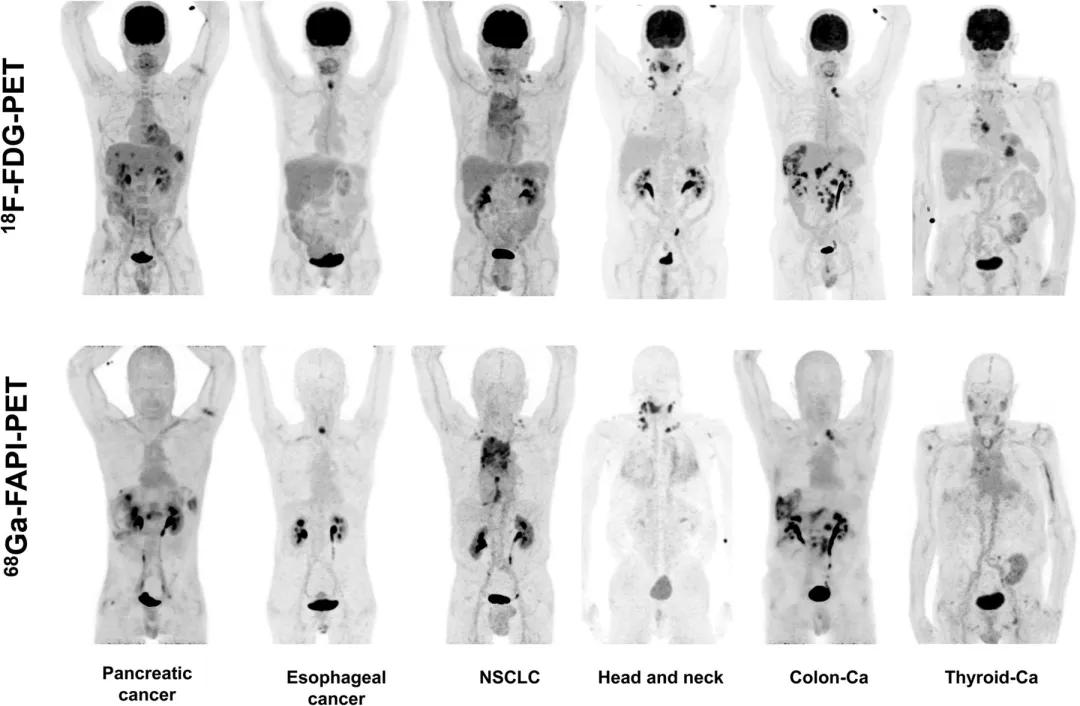 图14 六种不同肿瘤