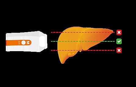 使更多的患者受益！ Fibroscan：与肝脏功能的诊断