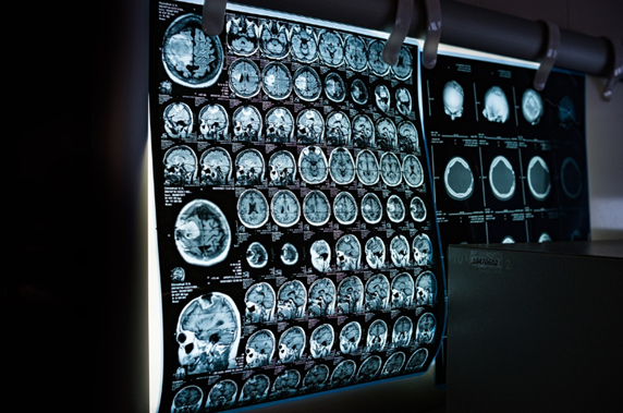 CT辐射致癌 一年几次CT算安全 真相来了！