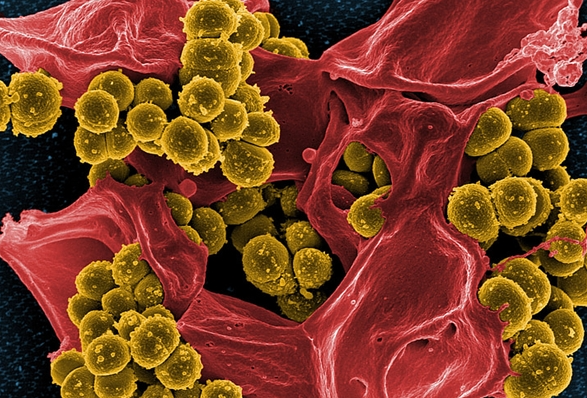 女子听信偏方感染超级细菌 医生：当心“毒草”偏方陷阱