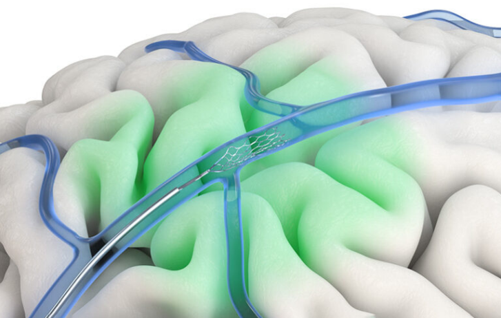 Synchron 的旗舰产品 Stentrode ，通过血管连接大脑