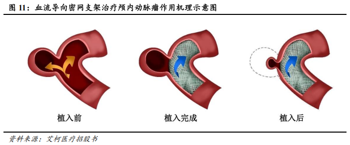 器械包括什么医疗器械行业深度：神经介入行业，大空间，新机遇_https://www.jmylbn.com_新闻资讯_第9张