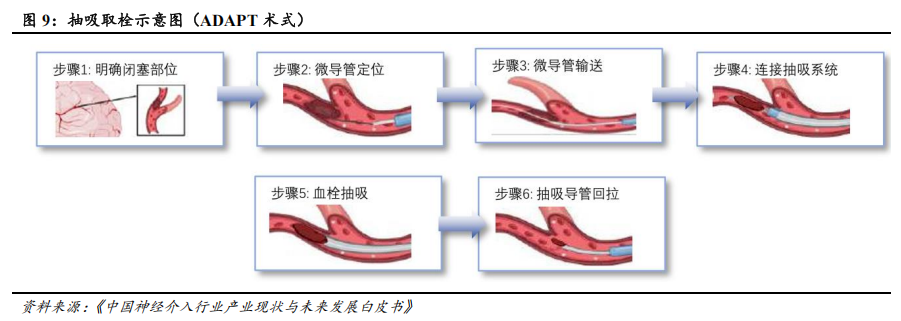 器械包括什么医疗器械行业深度：神经介入行业，大空间，新机遇_https://www.jmylbn.com_新闻资讯_第7张