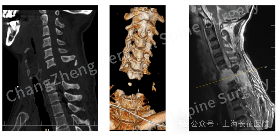 ▲ 影像检查显示患者颈椎罕见大跨度脱落，图源“上海长征医院”公众号，下同