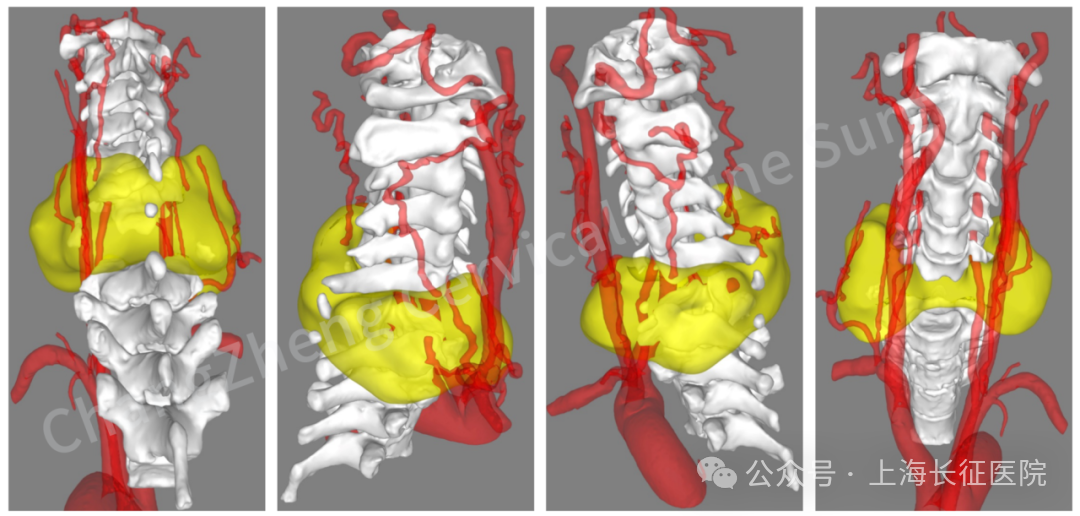 ▲ CT 三维重建提示颈椎离断部位情况严重复杂