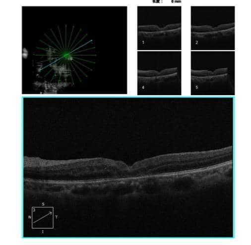 术后OCT，黄斑裂孔已闭合