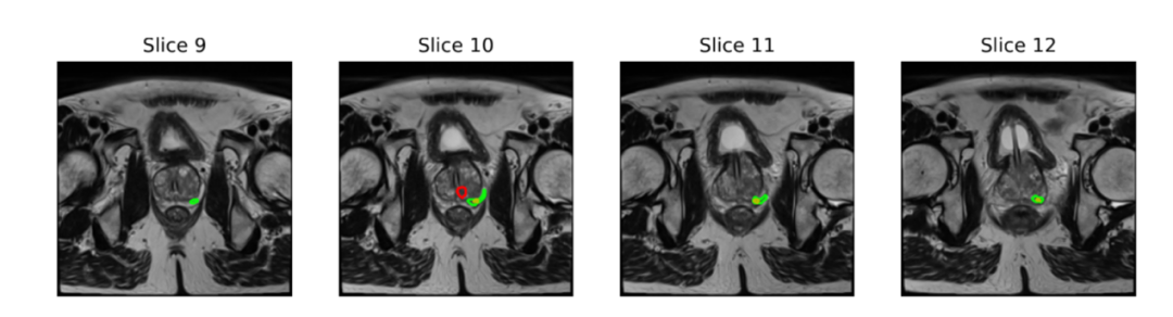图丨病灶标注对比示例：人类专家（红色轮廓）、AI（黄色轮廓）与数据集中的专家标注（绿色轮廓）（来源：arXiv）