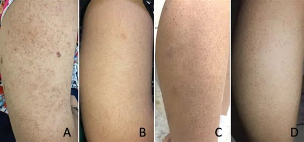 图 3. 不同程度的鸡皮肤（来自参考资料）