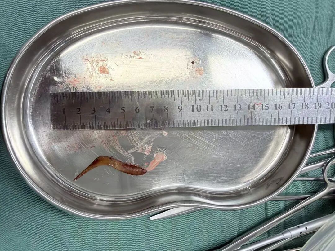 男子甲鱼骨卡喉吞饭“自救”致腹腔感染 医生紧急提醒