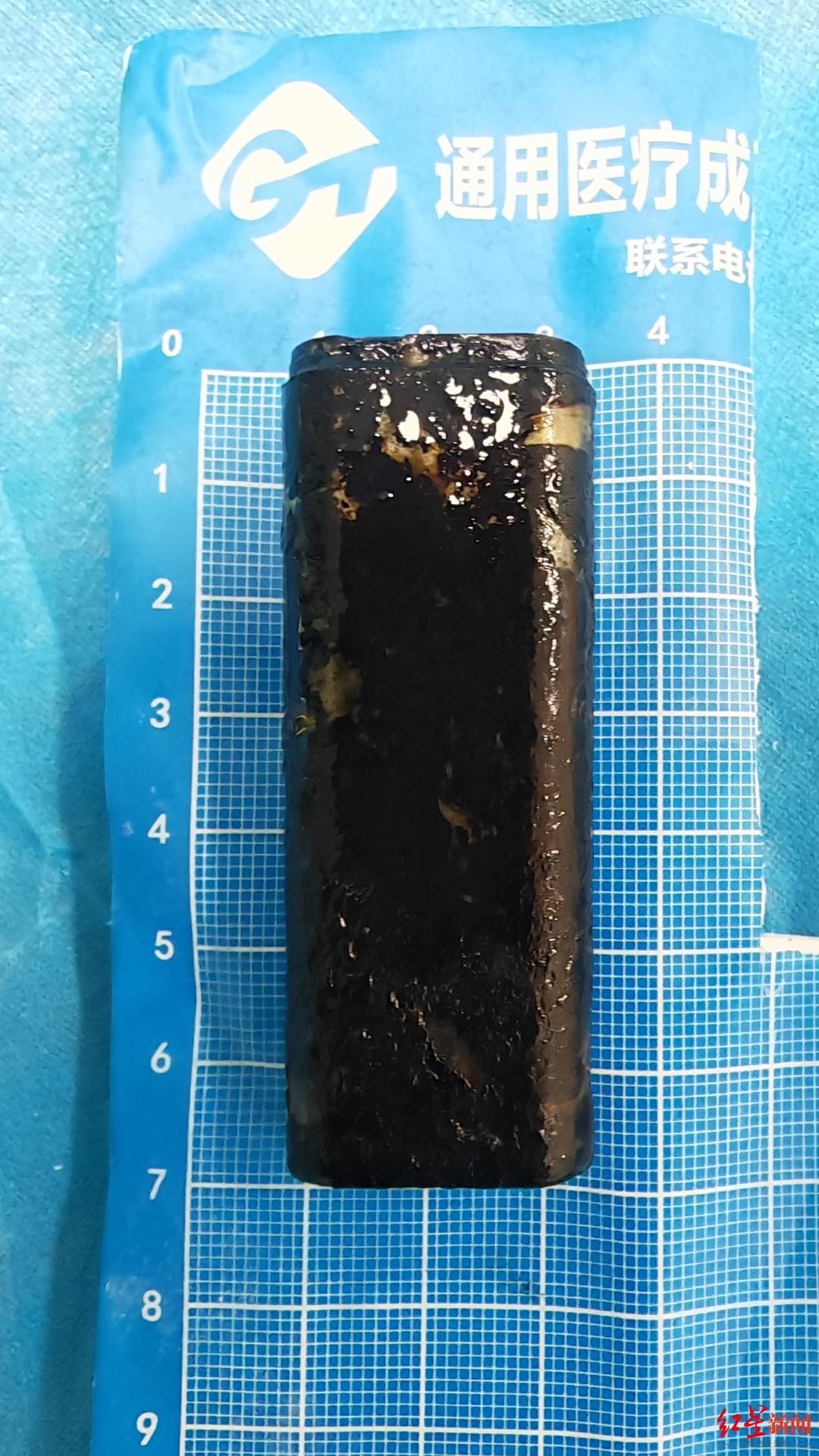 酒后打赌吞下打火机，大爷30年没当回事！取出时已泡黑……