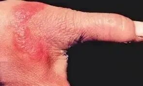 图片来源于《中国临床皮肤病学》