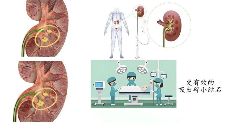 输尿管鞘是什么可控弯曲输尿管鞘导管及附件_https://www.jmylbn.com_新闻资讯_第2张