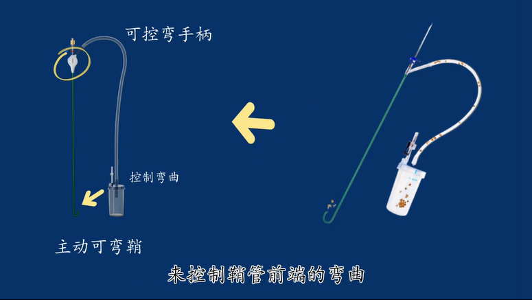 输尿管鞘是什么可控弯曲输尿管鞘导管及附件_https://www.jmylbn.com_新闻资讯_第1张