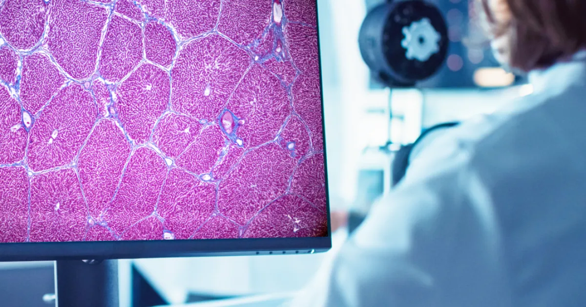 美国 FDA 批准首款人工智能药物研发工具，助力脂肪肝临床试验评估