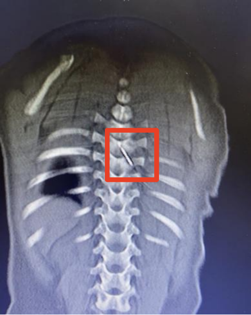 惊险！约3厘米长缝衣针裹被子里，扎入9月龄宝宝脊柱 ，医生：针的位置极其刁钻