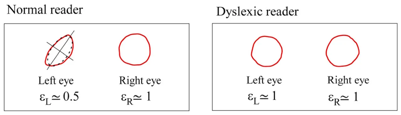 ▲ 左边是正常人的眼球，右边是阅读障者的眼球
