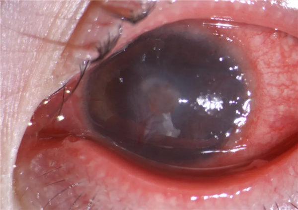 女子患流感5天不摘隐形眼镜近乎融化 医生：严重会造成永久性视力损伤