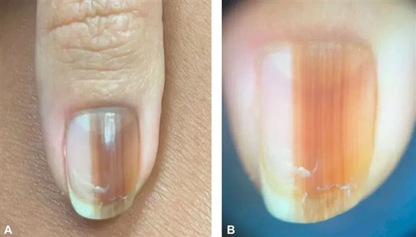 刚开始出现的甲黑色素瘤。图片来自参考资料