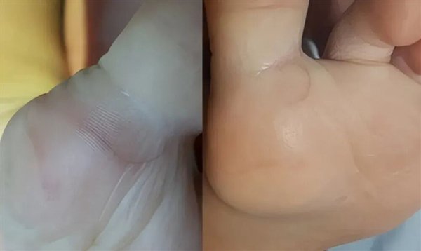 图7. 皮肤毛发移行疹（引自参考资料）