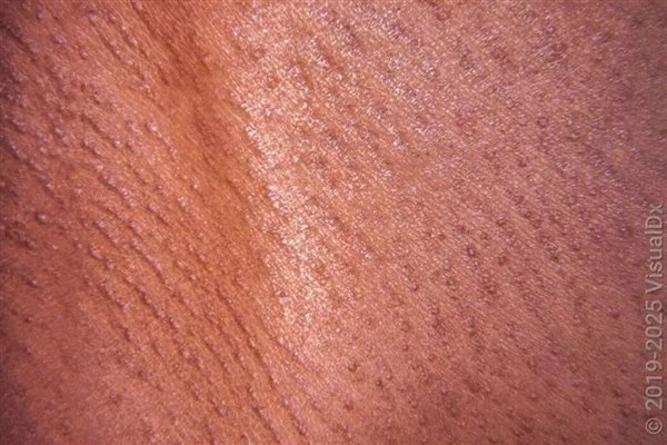 典型的漏斗部毛囊炎。图片来自于参考资料