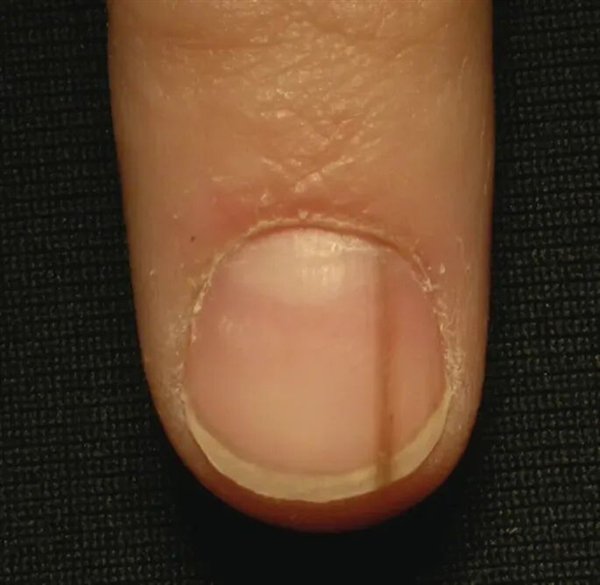图8. 良性的甲黑线（来自参考资料）